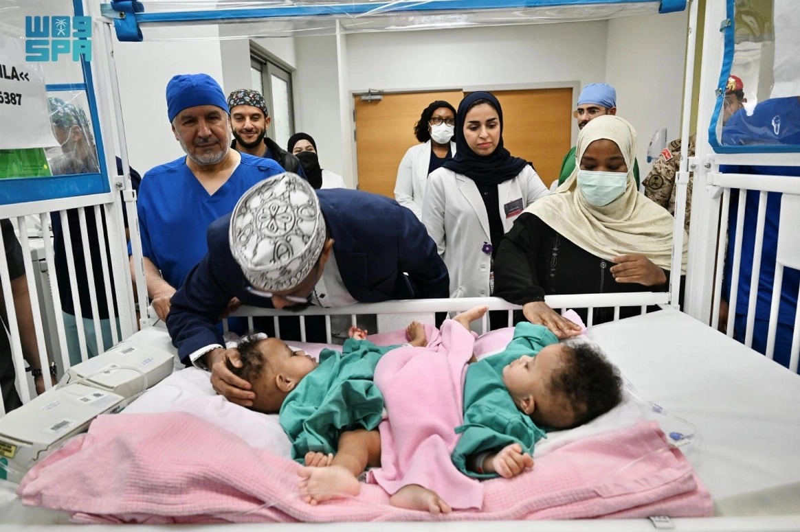 സൊമാലിയന്‍ സയാമീസ് ഇരട്ടകളെ വേര്‍പെടുത്തുന്ന ശസ്ത്രക്രിയ റിയാദില്‍ ആരംഭിച്ചു